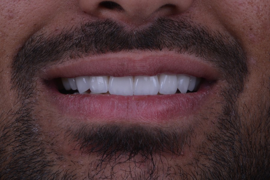 بعد تغير لون و شكل الأسنان لإعادة تأهيل الابتسامة.